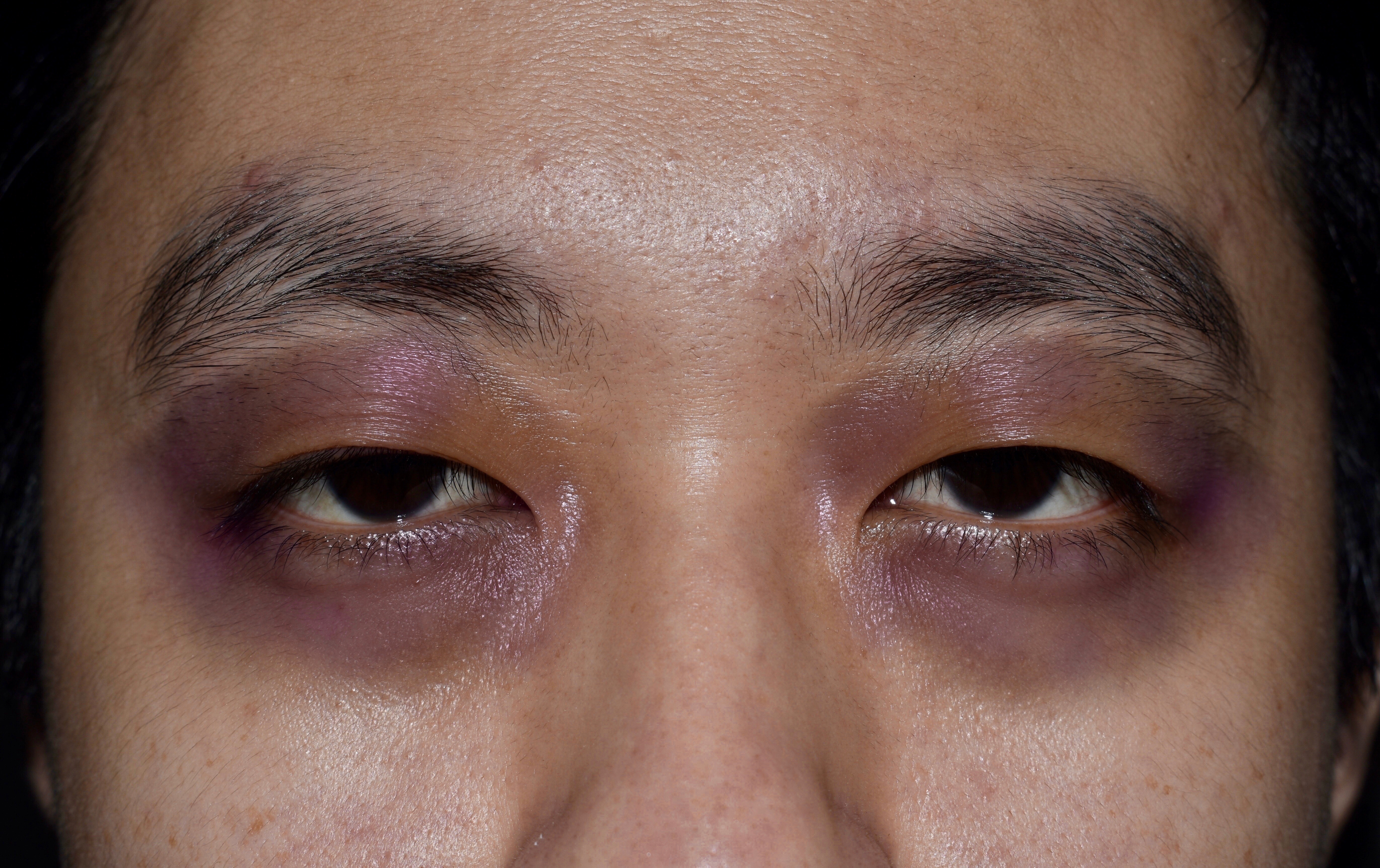 How to Identify If You Have Dark Circles and What Makes Them Worse