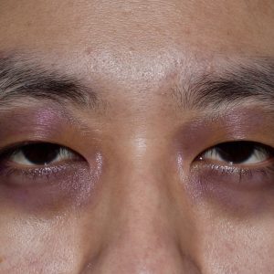 How to Identify If You Have Dark Circles and What Makes Them Worse