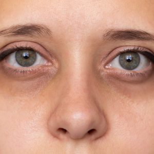 Why Adults Get Dark Circles: Insights