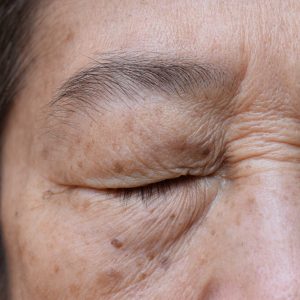 What Are Dark Spots Around the Eyes? Causes and Types